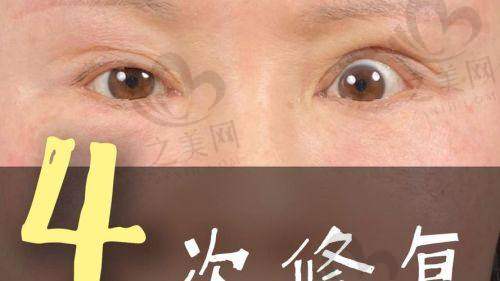 眼修复手术后的护理要点有哪些