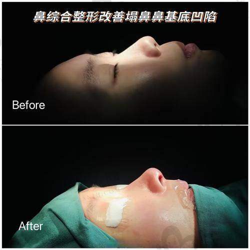 广州做鼻子的费用情况