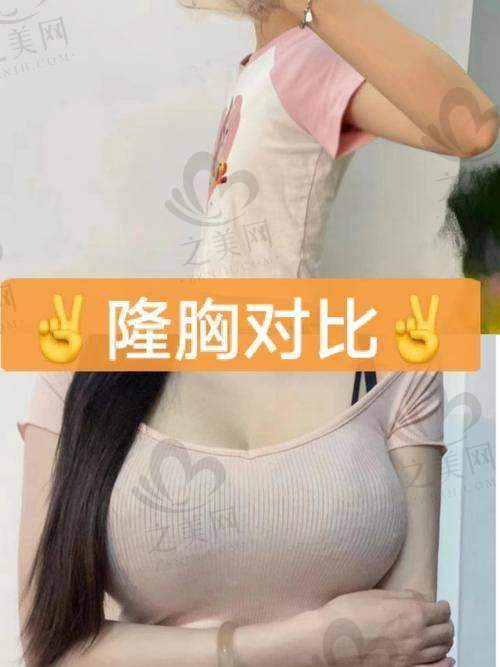 刘中策医生的美胸技术