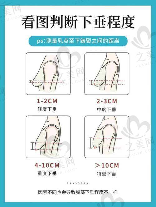孙泽芳医生脂肪丰胸项目优势