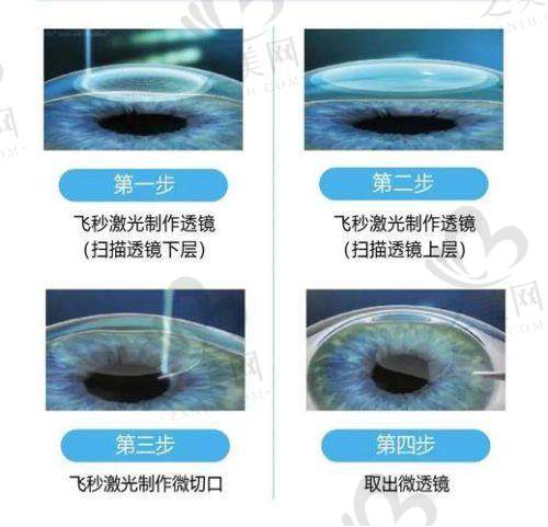 乌鲁木齐普瑞眼科医院价格与其他医院对比如何
