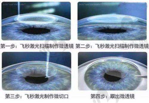 赣州爱尔眼科医院近视手术价格