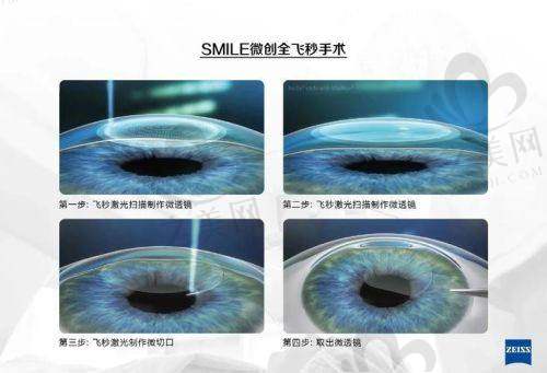 赣州爱尔眼科医院白内障手术价格