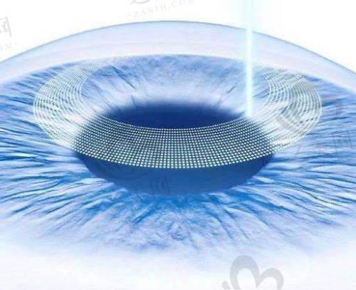 乌鲁木齐普瑞眼科医院2025年近视手术价格表