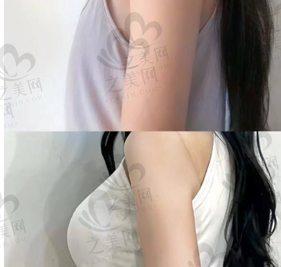 北京纯脂脂肪专科冯斌团队脂肪隆胸299000元起,罩杯提升塑形佳,多案例见证成效