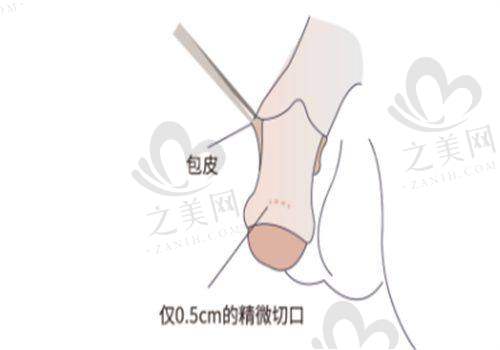 吸脂项目情况