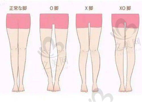 双眼皮手术常见问题解答