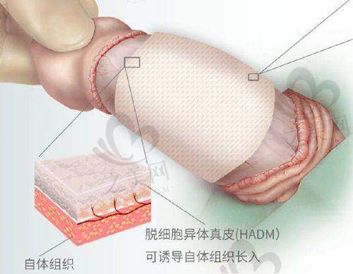 做鼻子项目情况