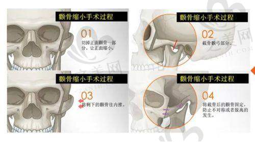 做小 v 脸手术的难度与风险