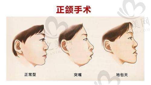 选择轮廓针注射的注意事项