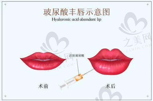 深圳宝丽7D聚拉提价格与服务质量的关系