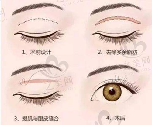 为何选择该门诊部做双眼皮