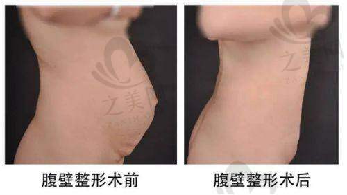 脸颊填充排名情况
