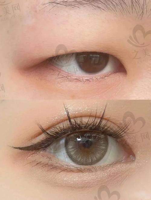 杭州艺星杨连华眼综合手术风格如何？