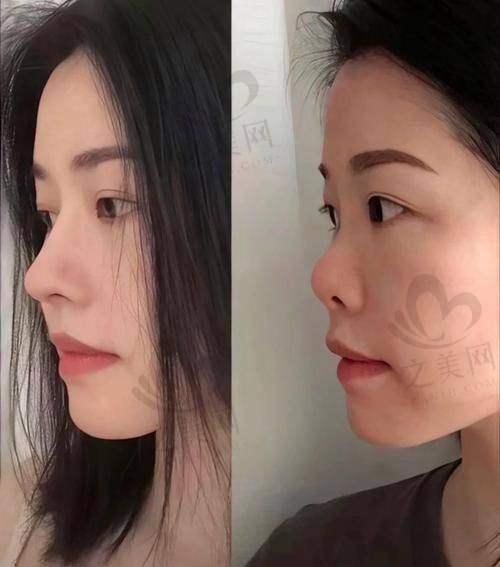 乌鲁木齐华美医院部分隆鼻项目价格