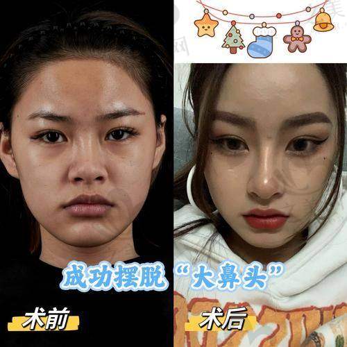 合肥鼻中隔偏曲手术价格