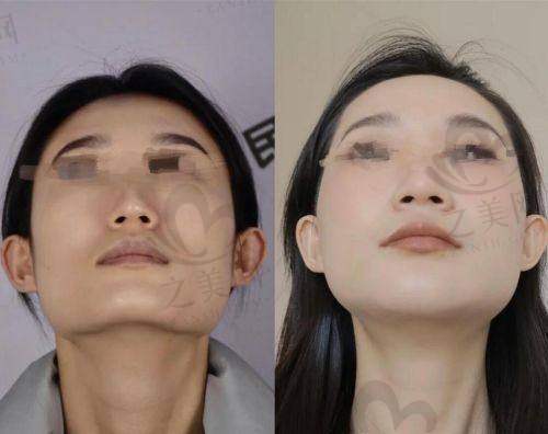 深圳下颌磨骨价格