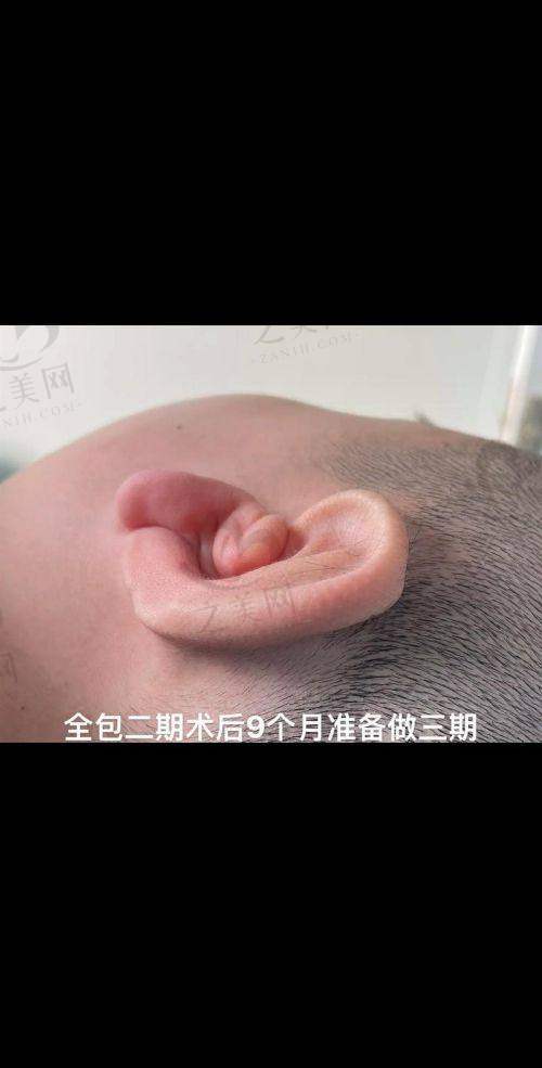 硅胶假耳朵价格整体情况