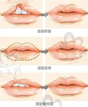 影响M唇手术价格的医院因素