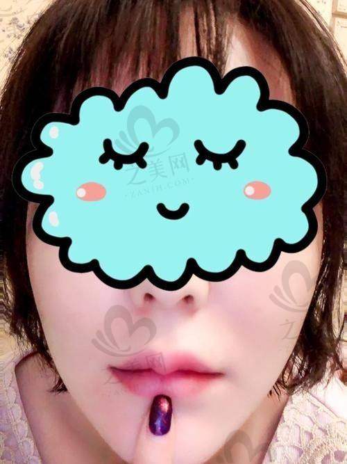 漂唇手术价格分析