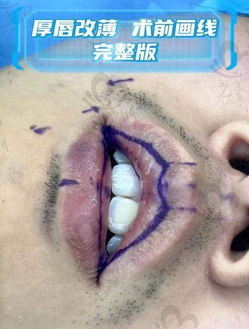 东莞台心医院兔唇修复的价格分析