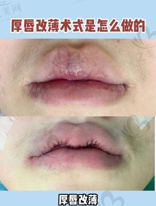 广州高尚和西安国医唇裂修复技术对比