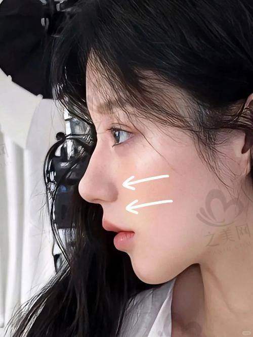 潍坊做鼻子得花多少钱,哪家医院做隆鼻好,宝尼达和濡白天使哪个打鼻子更合适,都在这