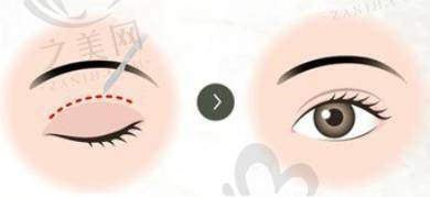 眼整形医生余东坐诊上海老牌医美机构,擅多领域整形,技术优口碑好,附预约方式及注意事项