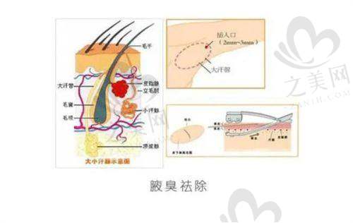 选择合适的激光祛斑医院和方案