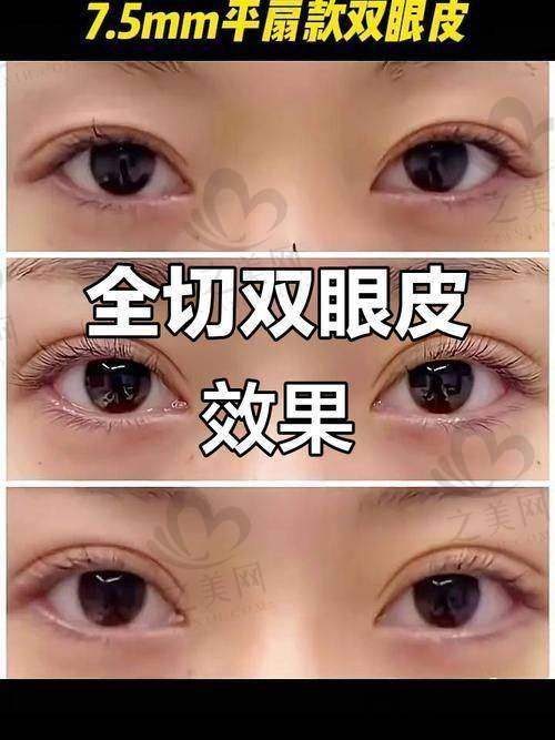 不同眼整形项目解析