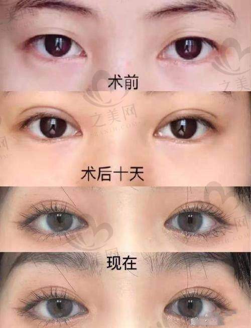 师丽丽医生双眼皮修复综合评价