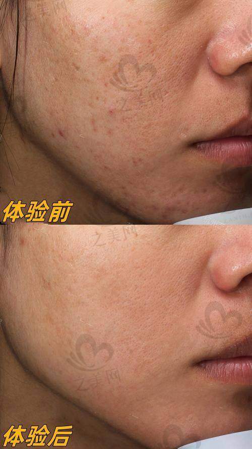 重庆光子嫩肤价目表更新!基础 OPT/IPL 单次价格 300 - 800 元,适合基础保养人群;高端超光子单次 800