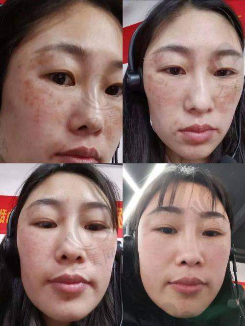 激光设备对价格的影响