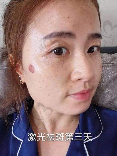 乌鲁木齐激光祛斑医院推荐——新疆黎美整形美容门诊