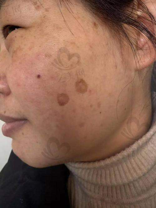 洛阳激光点痣价格情况