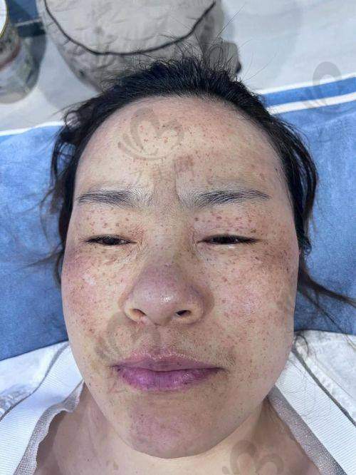 重庆激光祛斑价格的实际参考性