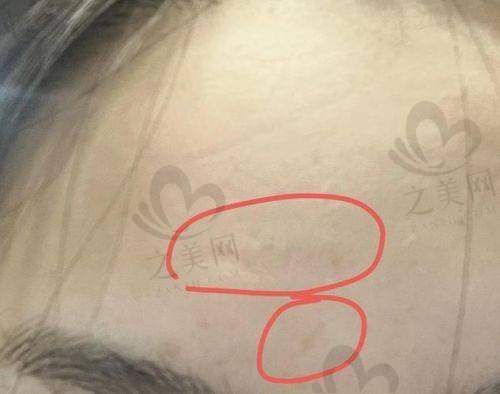 不同疤痕类型的治疗方案及价格影响因素