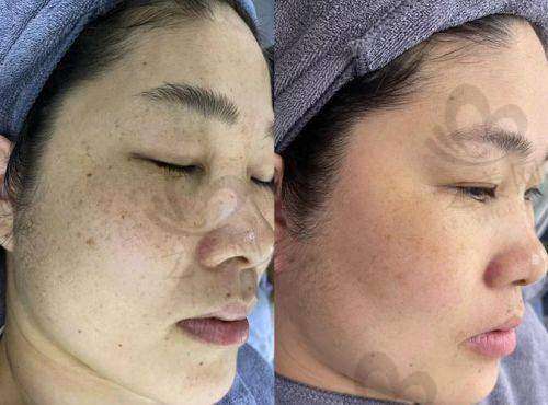 汕头华美与曙光双眼皮价格大公布,哪家更划算?看医院优惠整形价格表来比较