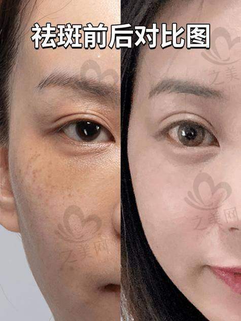 活动补贴