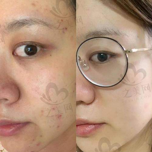北京协和医院整形美容外科光子嫩肤价格揭秘