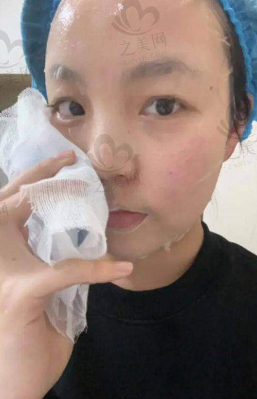 北京大学口腔医院第二门诊部不同设备类型的光子嫩肤价格