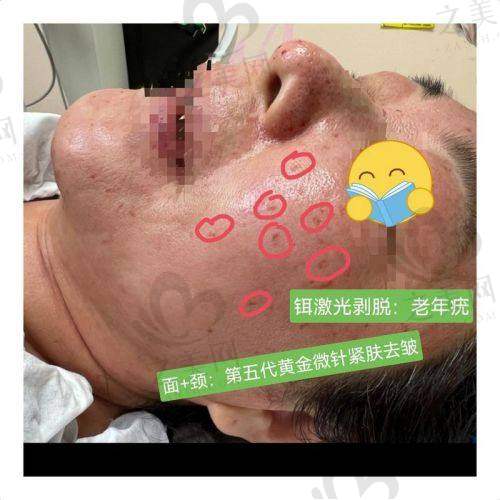北京光子嫩肤价格及医院推荐:基础光子嫩肤800元起,推荐协和/北京艺星/北京京城皮肤医院等