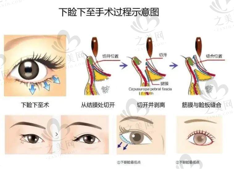 北京黄寺整形外科杜太超下睑矫正术技术优势:提供个性化方案,有效提升眼部的整体美感