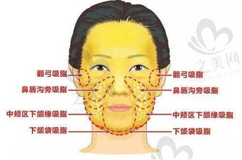 眼周眶隔年轻术的技术优势