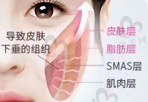 成都素美卢元刚医生的微拉皮技术