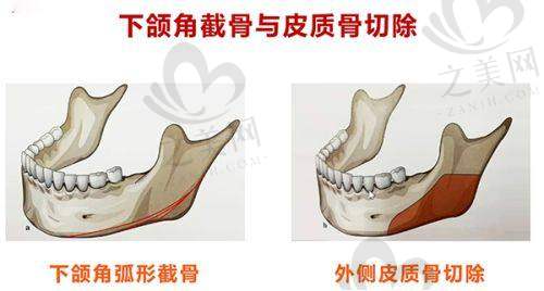 长沙希美轮廓固定的个性化选择