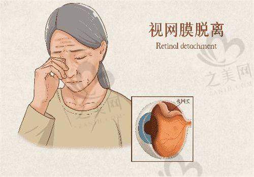 (二)白内障手术价格