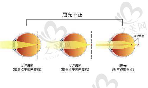 1. 近视矫正手术价格