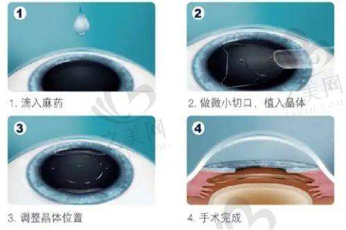 广州鸿视眼视光中 心的项目价格