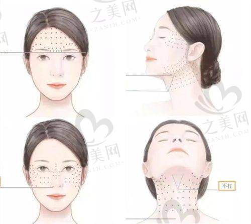 拉皮实例多且不留疤
